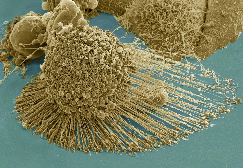Scanning electron micrograph of an apoptotic HeLa cell